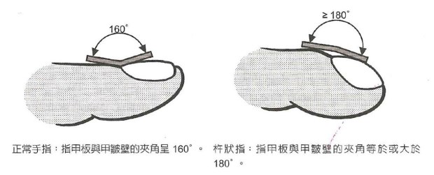 怎樣看出心臟有問題 從手指、舌頭眼神測試