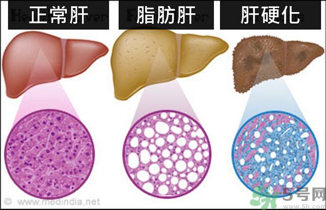 得了脂肪肝該怎么治？脂肪肝對人體危害有多大？