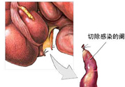 闌尾手術(shù)會影響結(jié)腸嗎？闌尾手術(shù)術(shù)后要注意什么？