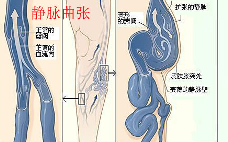 蚯蚓腿是怎么造成的？蚯蚓腿的因素分析