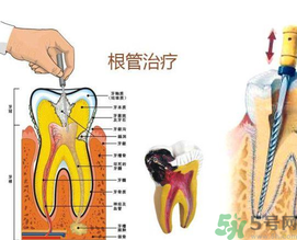 什么是根管治療？為什么牙齒疼要做根管治療？