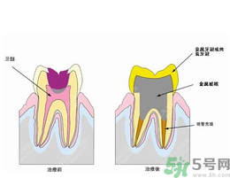 什么是根管治療？為什么牙齒疼要做根管治療？