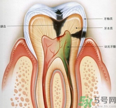 什么是根管治療？為什么牙齒疼要做根管治療？