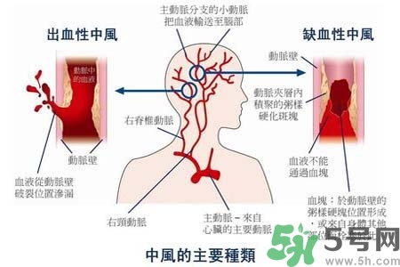 腦中風(fēng)是什么？腦中風(fēng)的癥狀？