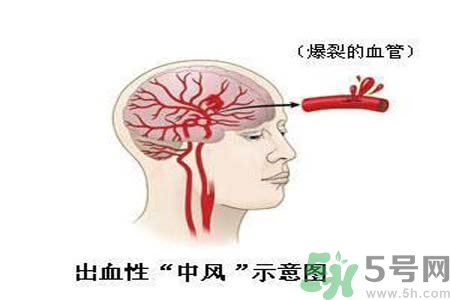 腦中風(fēng)的護(hù)理措施？腦中風(fēng)的飲食護(hù)理？