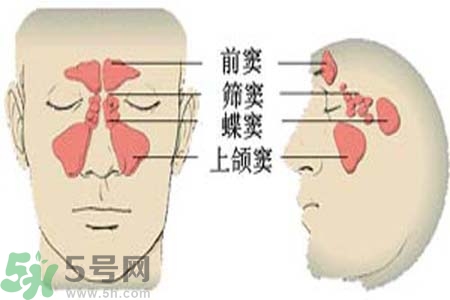 鼻竇炎是什么？鼻竇炎的癥狀有哪些？