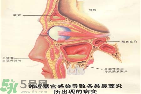 鼻竇炎是什么？鼻竇炎的癥狀有哪些？