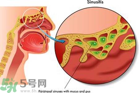 鼻竇炎的護(hù)理措施？鼻竇炎的飲食護(hù)理？