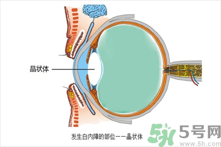 白內障的護理措施是什么？白內障的飲食護理有哪些？