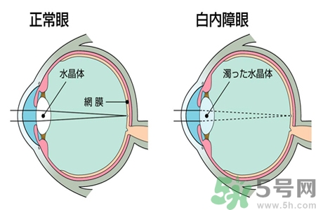 白內(nèi)障的發(fā)病因素是什么？白內(nèi)障并發(fā)癥有哪些？