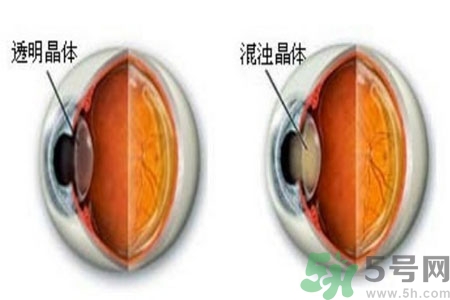 白內(nèi)障治療方法是什么？白內(nèi)障可以用什么藥物治療？