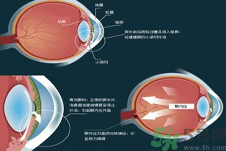 青光眼是什么？青光眼癥狀有什么？