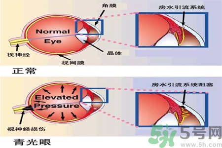 青光眼的護(hù)理措施有什么？青光眼的飲食護(hù)理有哪些？