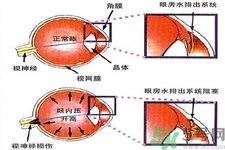 青光眼的發(fā)病因素是什么？青光眼的并發(fā)癥有哪些？