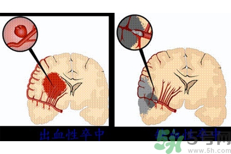 腦出血的發(fā)病因素是什么？腦出血的并發(fā)癥有哪些？