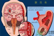 腦出血的發(fā)病因素是什么？腦出血的并發(fā)癥有哪些？