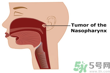 鼻咽癌的日常措施是什么？鼻咽癌注意的飲食有哪些？