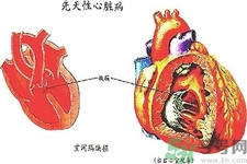 先天性心臟病發(fā)病原因是什么？