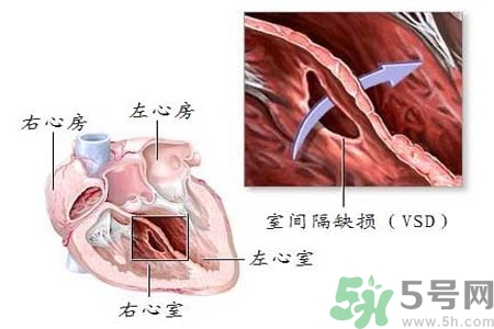 心臟病是怎么形成的？易發(fā)人群有哪些？