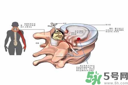 為什么年輕人容易得頸椎?。款i椎病嚴重的癥狀有哪些？