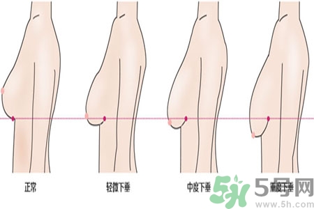 ?女性乳房下垂的原因是什么？女性乳房下垂的分類有哪些？