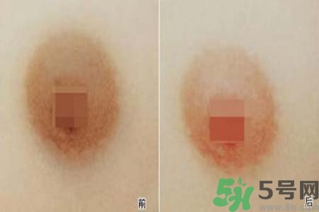 乳頭發(fā)黑怎么辦？怎么樣可以使乳頭變白？