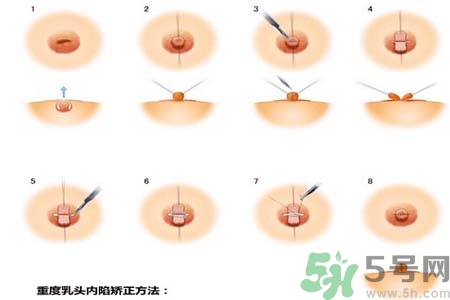 乳頭內(nèi)陷怎么回事？乳頭內(nèi)陷的原因是什么？