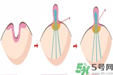 乳頭內(nèi)陷怎么辦？乳頭內(nèi)陷的癥狀有哪些？