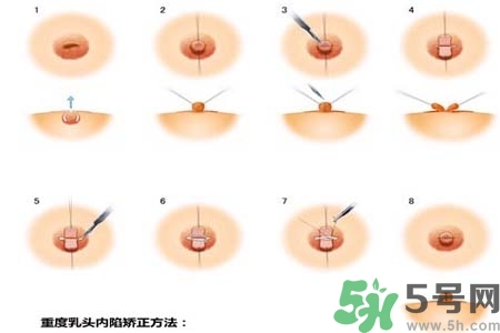 乳頭內(nèi)陷怎么辦？乳頭內(nèi)陷的癥狀有哪些？