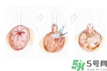 乳頭內(nèi)陷怎么辦？乳頭內(nèi)陷的癥狀有哪些？