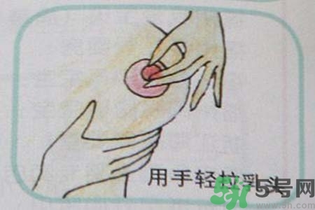 乳頭內(nèi)陷怎么辦？乳頭內(nèi)陷的癥狀有哪些？