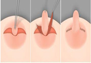 乳頭內(nèi)陷怎么辦？乳頭內(nèi)陷的癥狀有哪些？