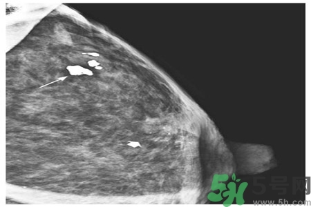 乳腺增生鈣化是什么？乳腺鈣化的癥狀有哪些？