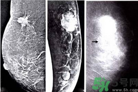 乳腺增生鈣化是什么？乳腺鈣化的癥狀有哪些？