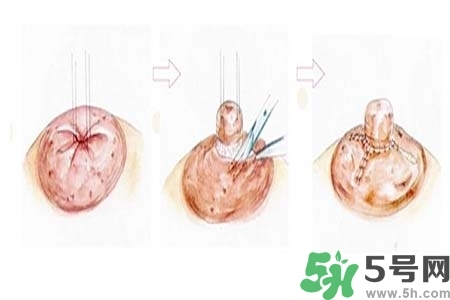 乳頭內(nèi)陷怎么矯正？乳頭內(nèi)陷矯正方法是什么？