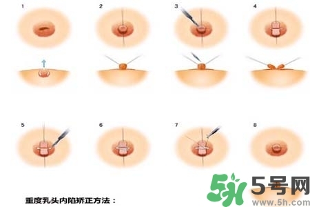 乳頭內(nèi)陷怎么矯正？乳頭內(nèi)陷矯正方法是什么？