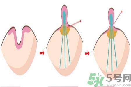 乳頭內(nèi)陷矯正需注意什么？乳頭內(nèi)陷如何預(yù)防？