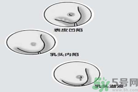 乳頭內(nèi)陷矯正需注意什么？乳頭內(nèi)陷如何預(yù)防？