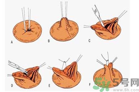 乳頭內(nèi)陷可以拔罐嗎？乳頭內(nèi)陷需要手術(shù)治療嗎？