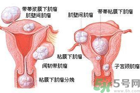 ?子宮移位怎么治療？子宮移位能懷孕嗎？