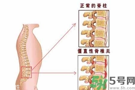 僵直性脊椎炎的癥狀有哪些？怎樣預(yù)防僵直性脊椎炎？