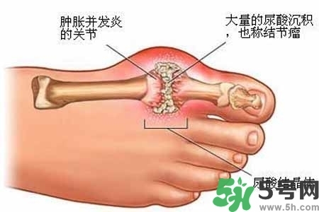 引發(fā)痛風(fēng)的原因是什么？痛風(fēng)病人飲食需注意什么好？