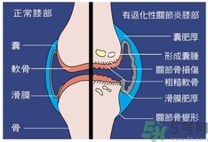 骨關(guān)節(jié)炎能治好嗎？骨關(guān)節(jié)炎平時注意事項