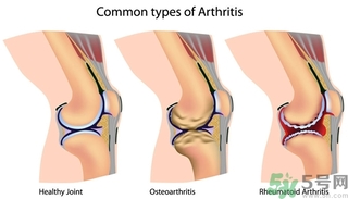 類風濕關節(jié)炎的診斷標準 類風濕關節(jié)炎的飲食選擇與禁忌