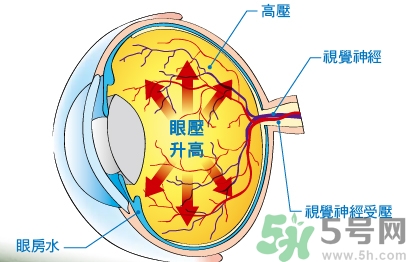 青光眼可以治愈嗎？青光眼怎樣治療？