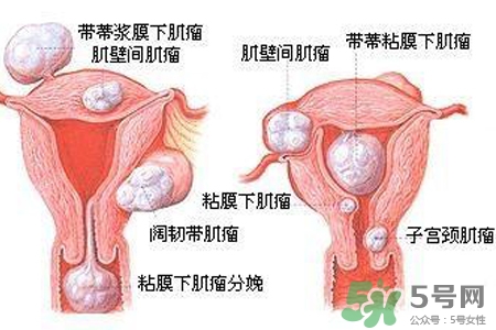 子宮小會(huì)影響生育嗎？子宮小會(huì)導(dǎo)致不孕嗎？