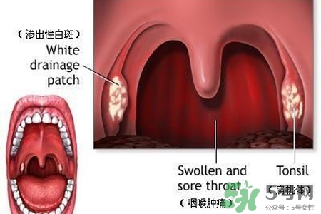 口含大蒜能治療咽炎嗎？巧用大蒜治療咽炎咳嗽