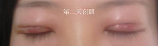 三點(diǎn)雙眼皮恢復(fù)過程圖_韓式三點(diǎn)雙眼皮多久恢復(fù)自然