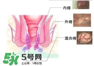 痔瘡吃什么藥效果好？痔瘡吃什么藥好得快？