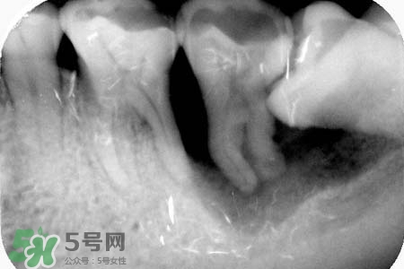 智齒會引起耳鳴嗎？耳鳴跟智齒有關(guān)系嗎？